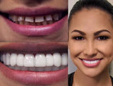 Invisible Orthodontic Veneers